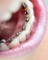 Lingual Braces Image